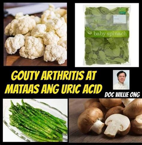 Gouty arthritis at mataas ang uric acid .